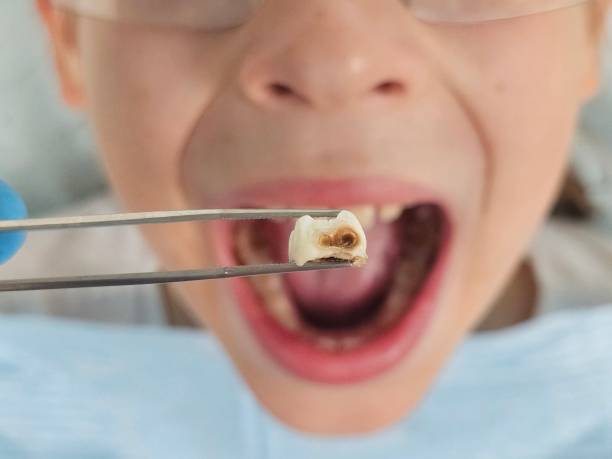 Best Emergency Wisdom Teeth Removal in Rhome, TX
